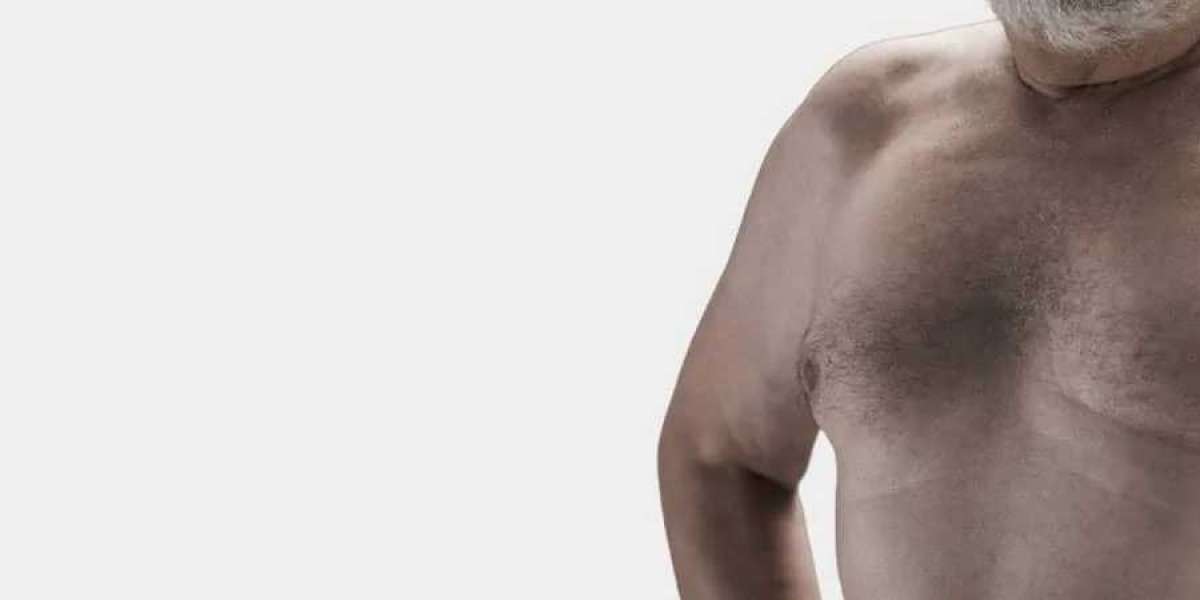 Top 10 Reasons to Consider Gynecomastia Surgery