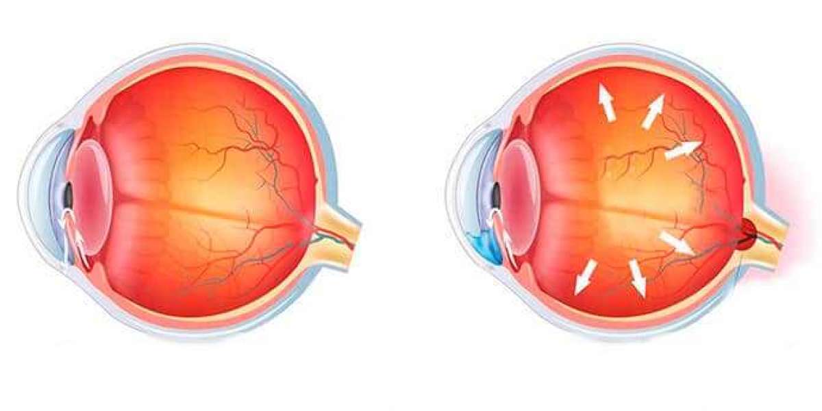 Understanding Glaucoma: Signs, Diagnosis, and Care Options